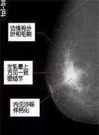 乳腺鉬靶